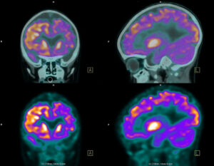 PET scan images