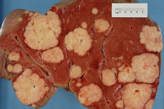 CT Pathology