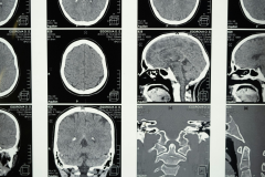 CT Procedures: Head and Neck